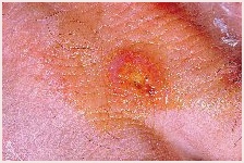 Cause of Skin Ulcers