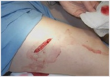 How Do You Treat a Laceration?